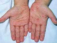 Hand Foot and Mouth Disease6